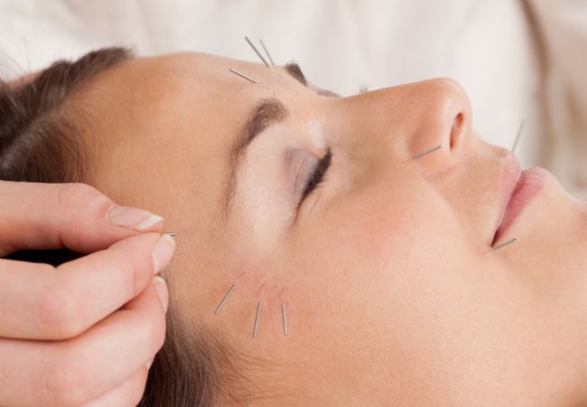 Facial Acupuncture 2 Facial Acupuncture in Boston with North End Acupuncture