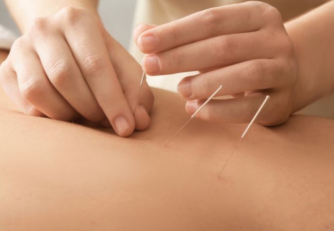 Acupuncture Services