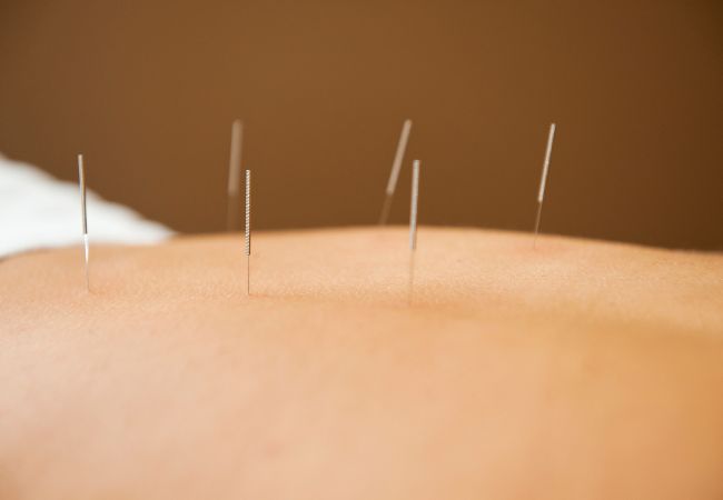 Acupuncture for Preventative Medicine Acupuncture for Preventative Medicine