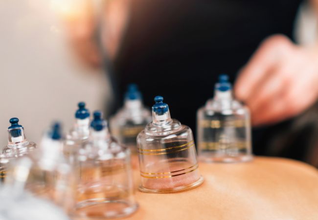 Cupping therapy Cupping therapy