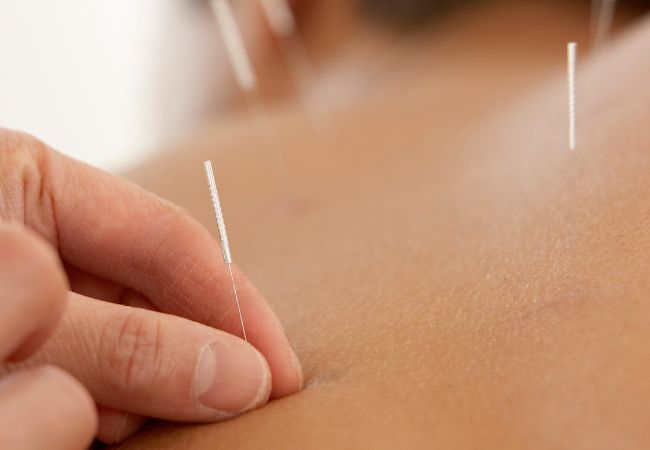 Is Acupuncture Safe for Kids? What Parents Should Know