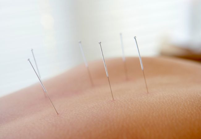 How Acupuncture Can Support Children’s Health Naturally