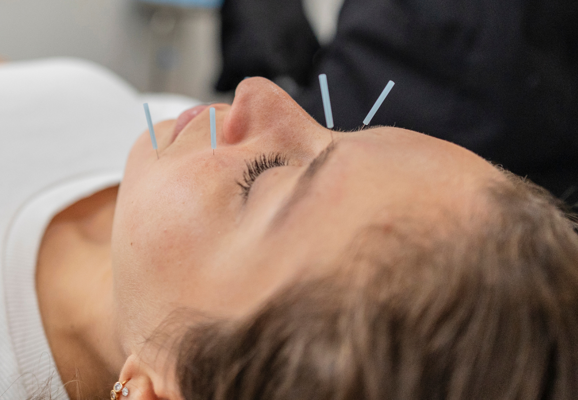 Facial Acupuncture in Boston with North End Acupuncture 