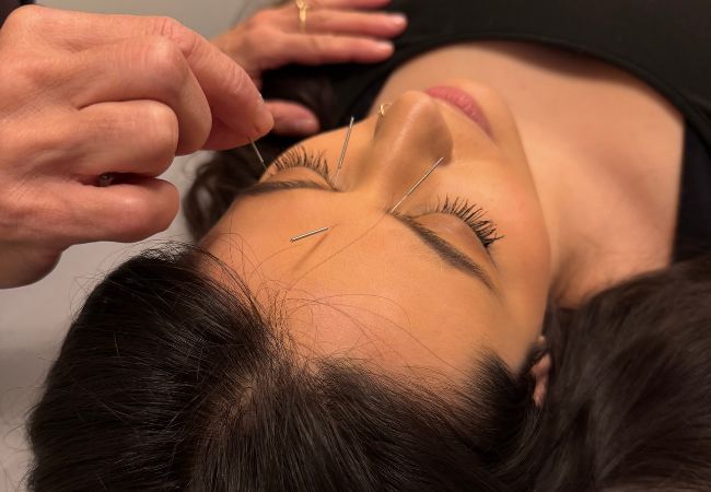 Cosmetic Acupuncture in Boston