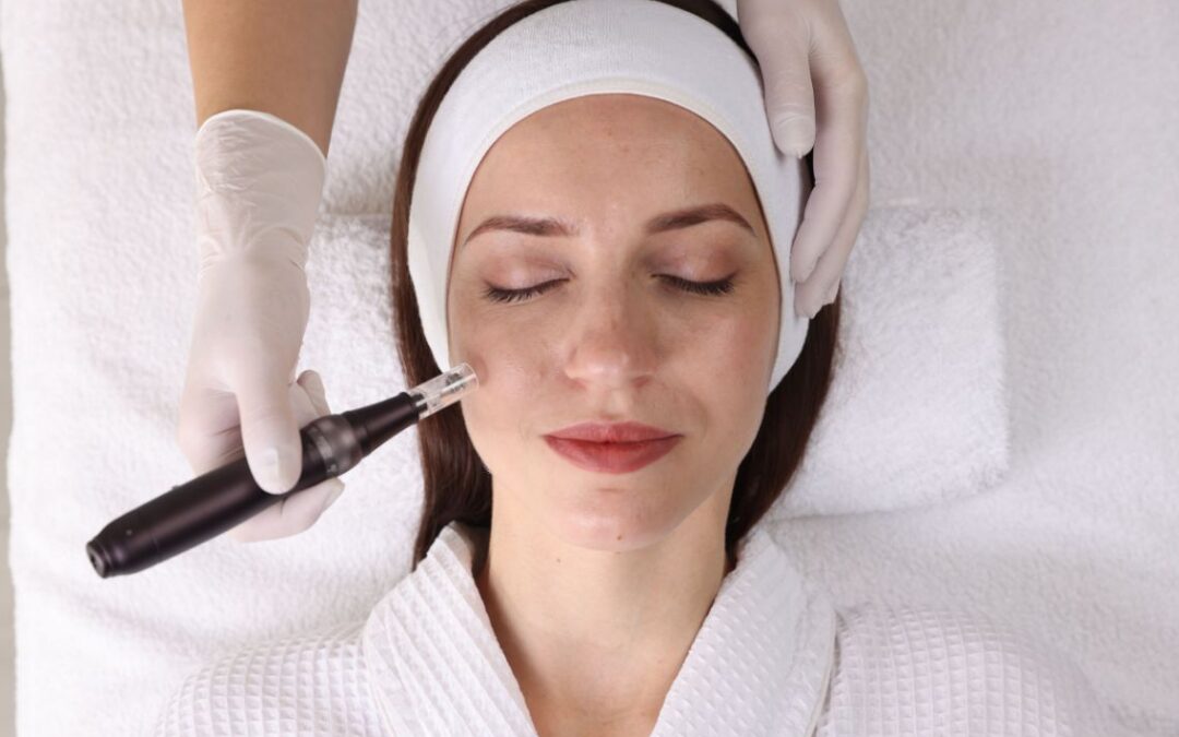 Microneedling in Boston: A Case Study on Acne Scarring, Skin Texture, and Natural Collagen Stimulation