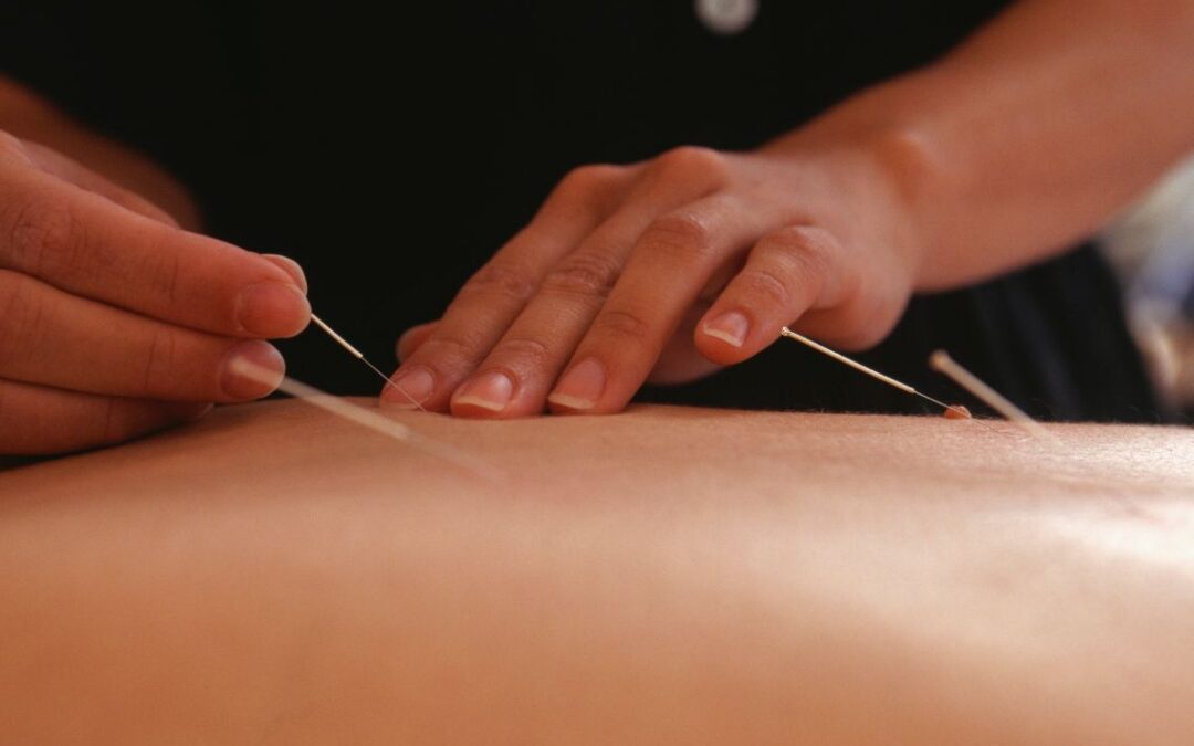 Acupuncture for Low Back Pain and Sciatica in Boston: A Case Study on Chronic Tension, Inflammation, and Mobility Recovery