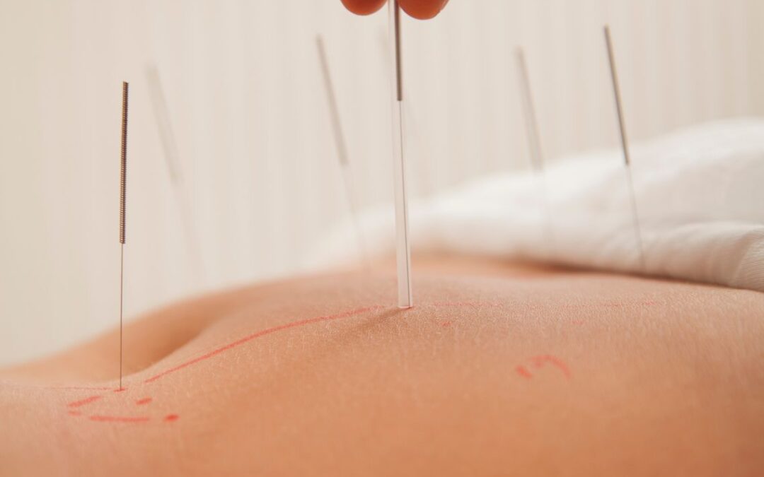 Fertility Acupuncture in Boston: A Case Study on PCOS, Failed IVF, and Natural Conception
