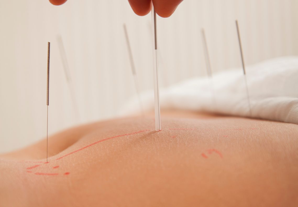 A Case Study on PCOS, Failed IVF, and Natural Conception Fertility Acupuncture in Boston: A Case Study on PCOS, Failed IVF, and Natural Conception